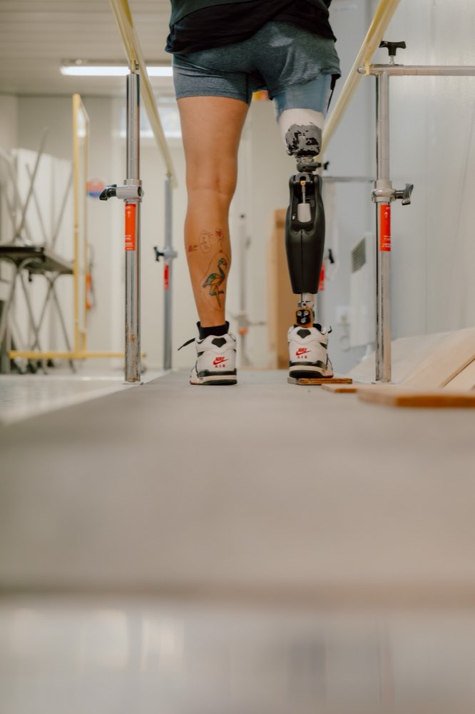 Patient appareillé d'une prothése de jambe lors d'un exercice de marche